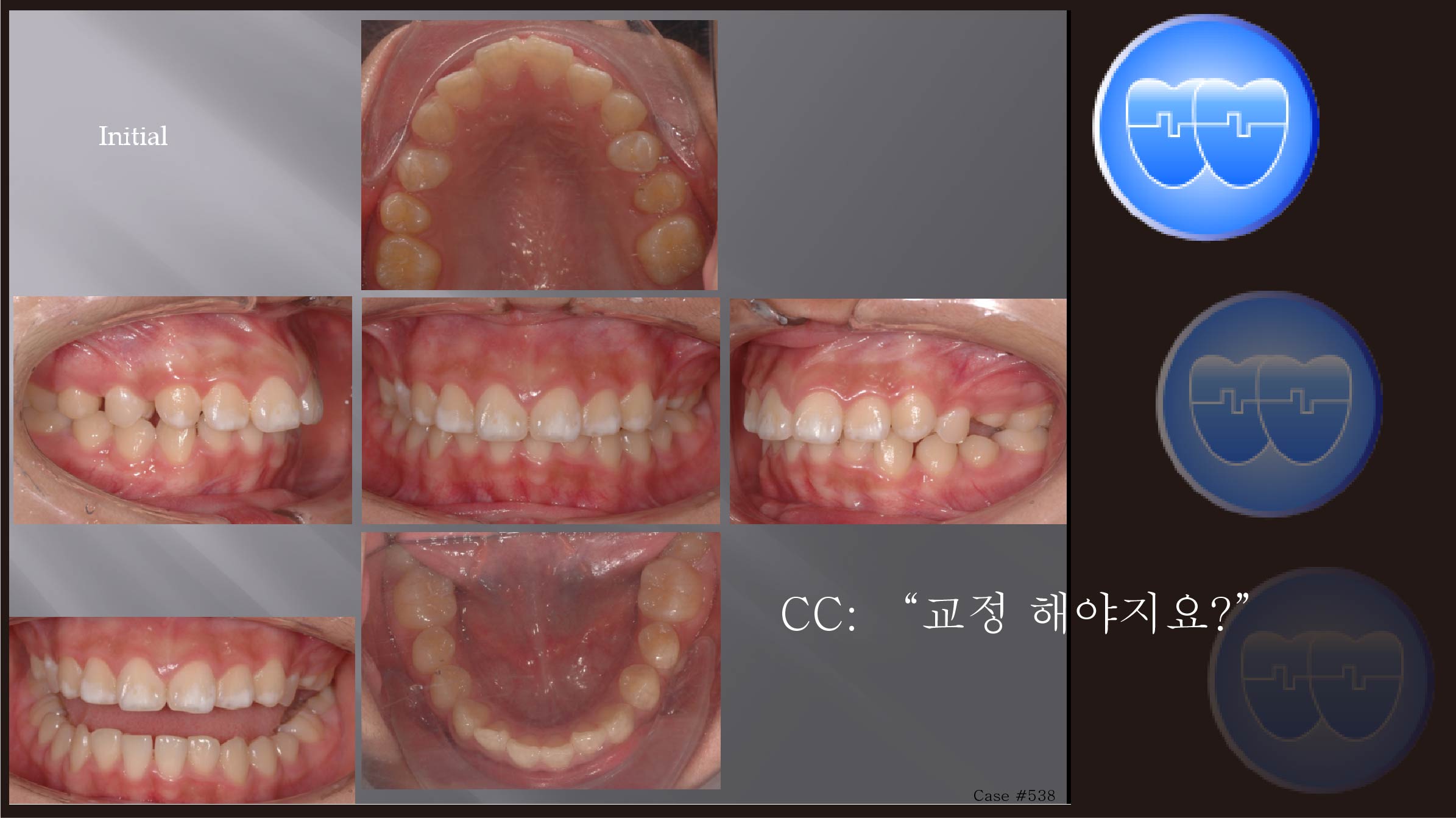 교정 Case 538.  비발치, Stripping, Gingivectomy, Class II, Sem #5