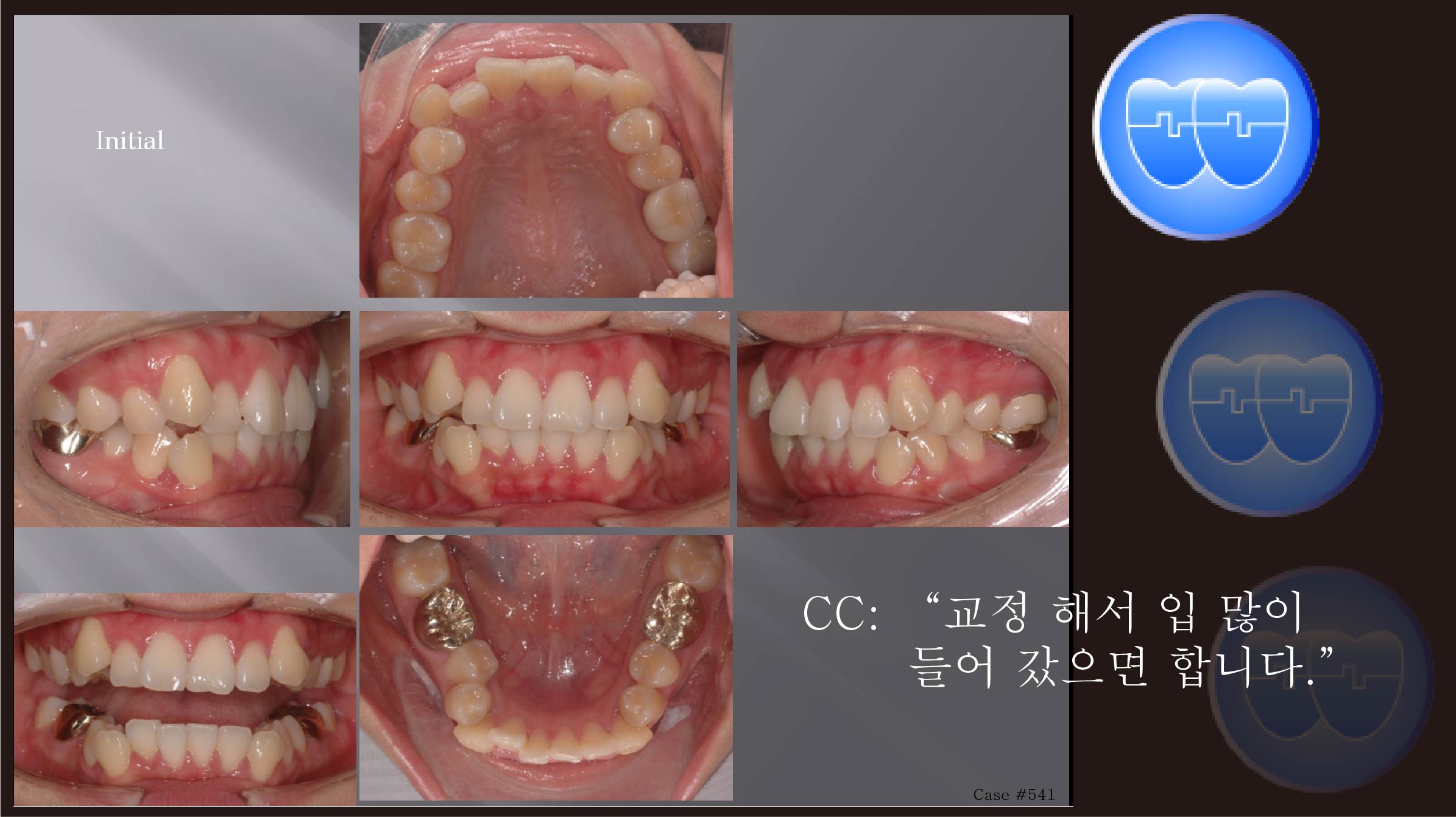 교정 Case 541.  U4L4 발치, Severe Crowding, Sem #12.1