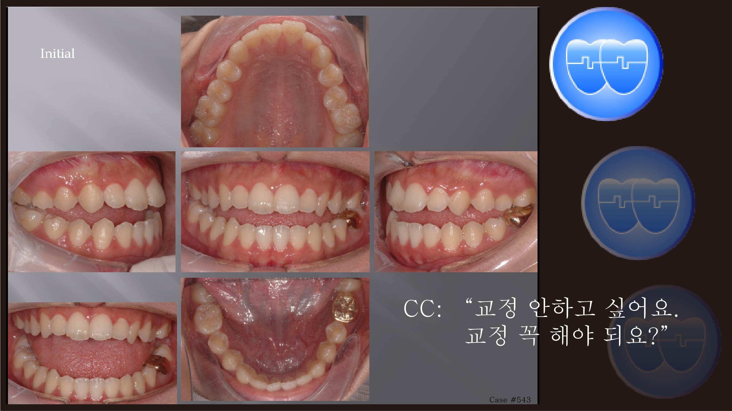 교정 Case 543.  L4 발치, Dental Openbite, Bonded RPE, Upper Palatal Corticotomy, Sem #7