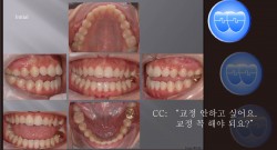 교정 Case 543.  L4 발치, Dental Openbite, Bonded RPE, Upper Palatal Corticotomy, Sem #7