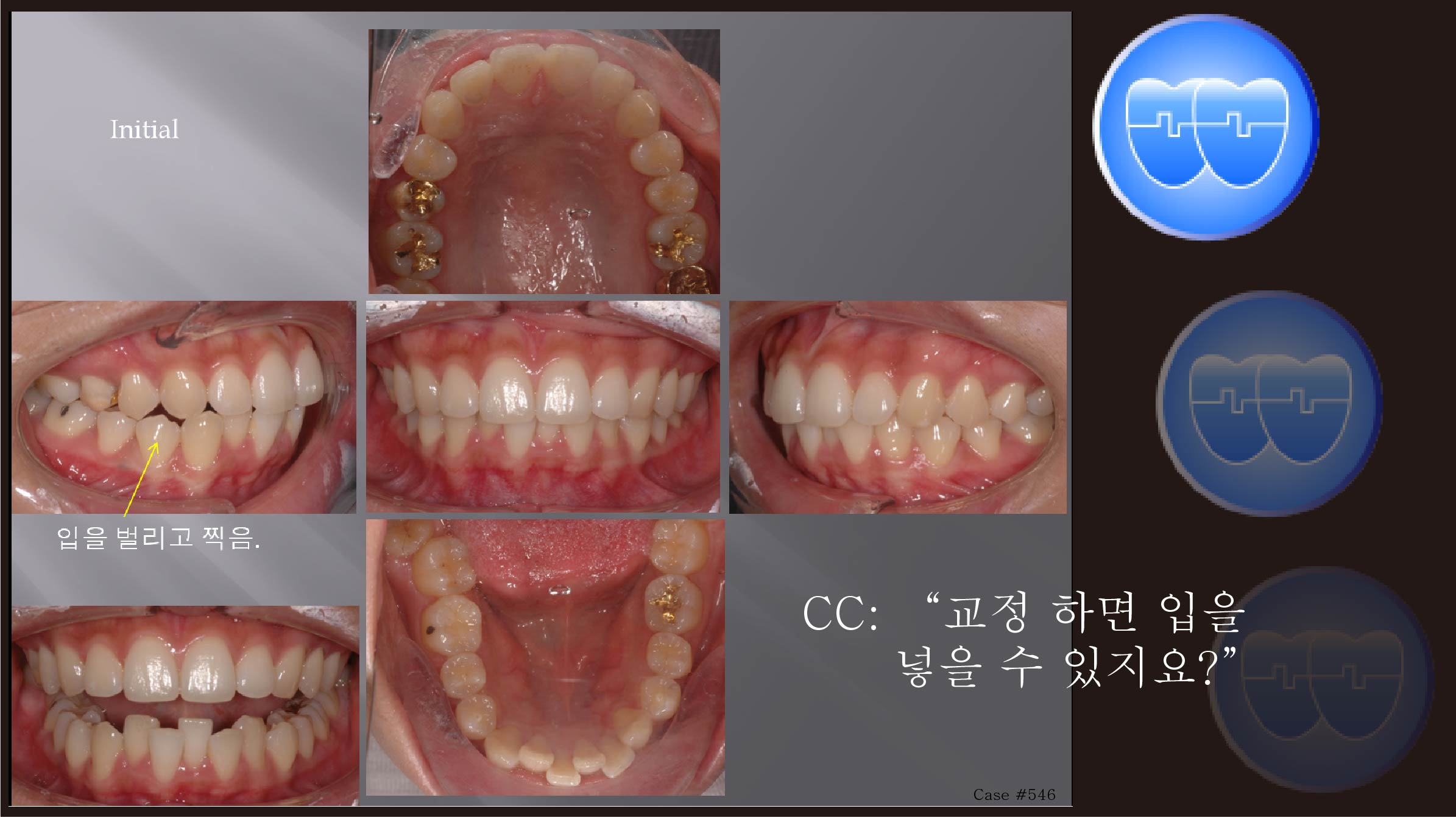 교정 Case 546.  U5L5 발치, Protrusion, Possible Gummy Smile, Sem 12.4