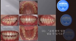 교정 Case 546.  U5L5 발치, Protrusion, Possible Gummy Smile, Sem 12.4