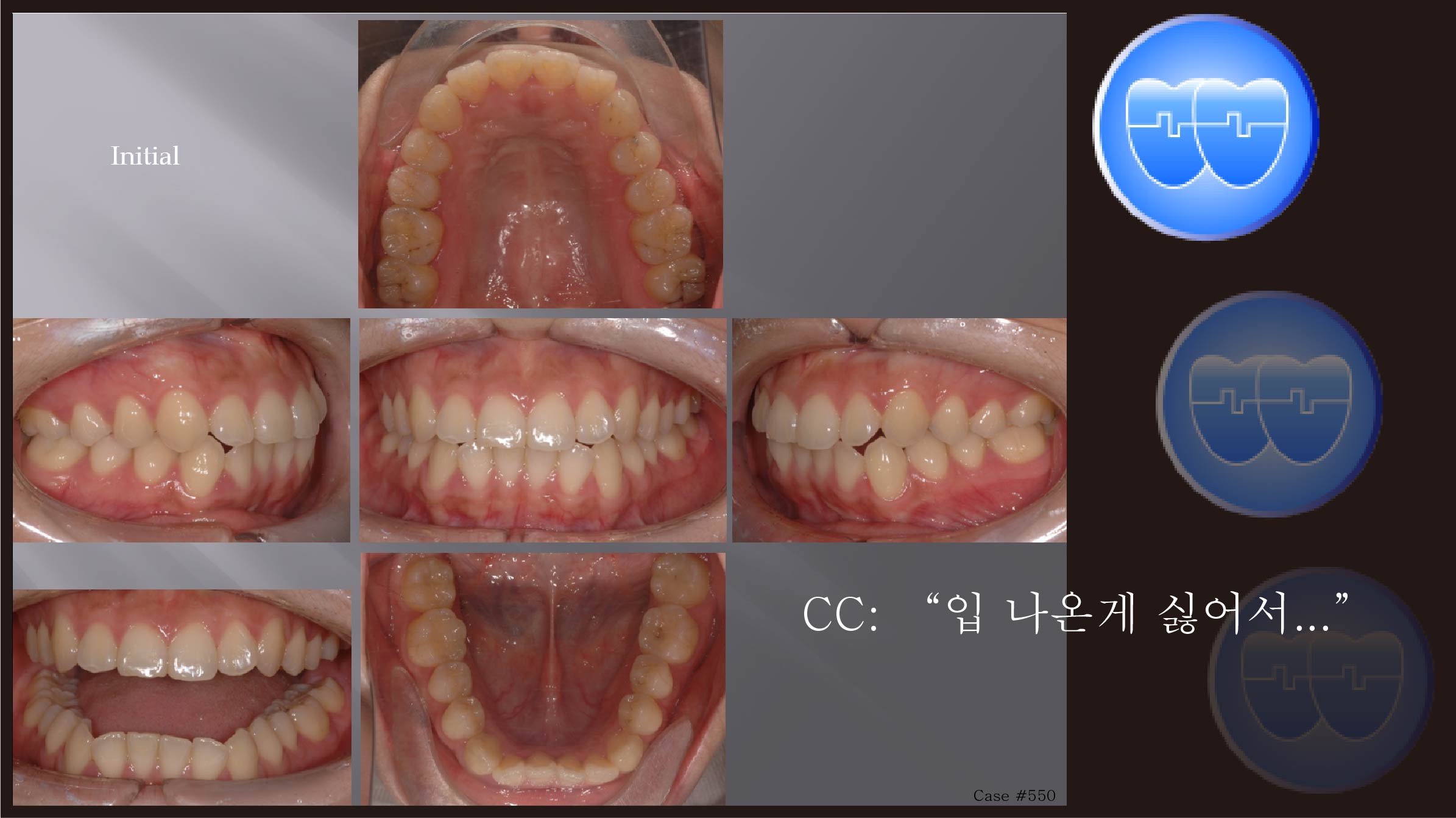 교정 Case 550.  U4L5 발치, Protrusion, Square Type Lower Arch, Sem #12.2