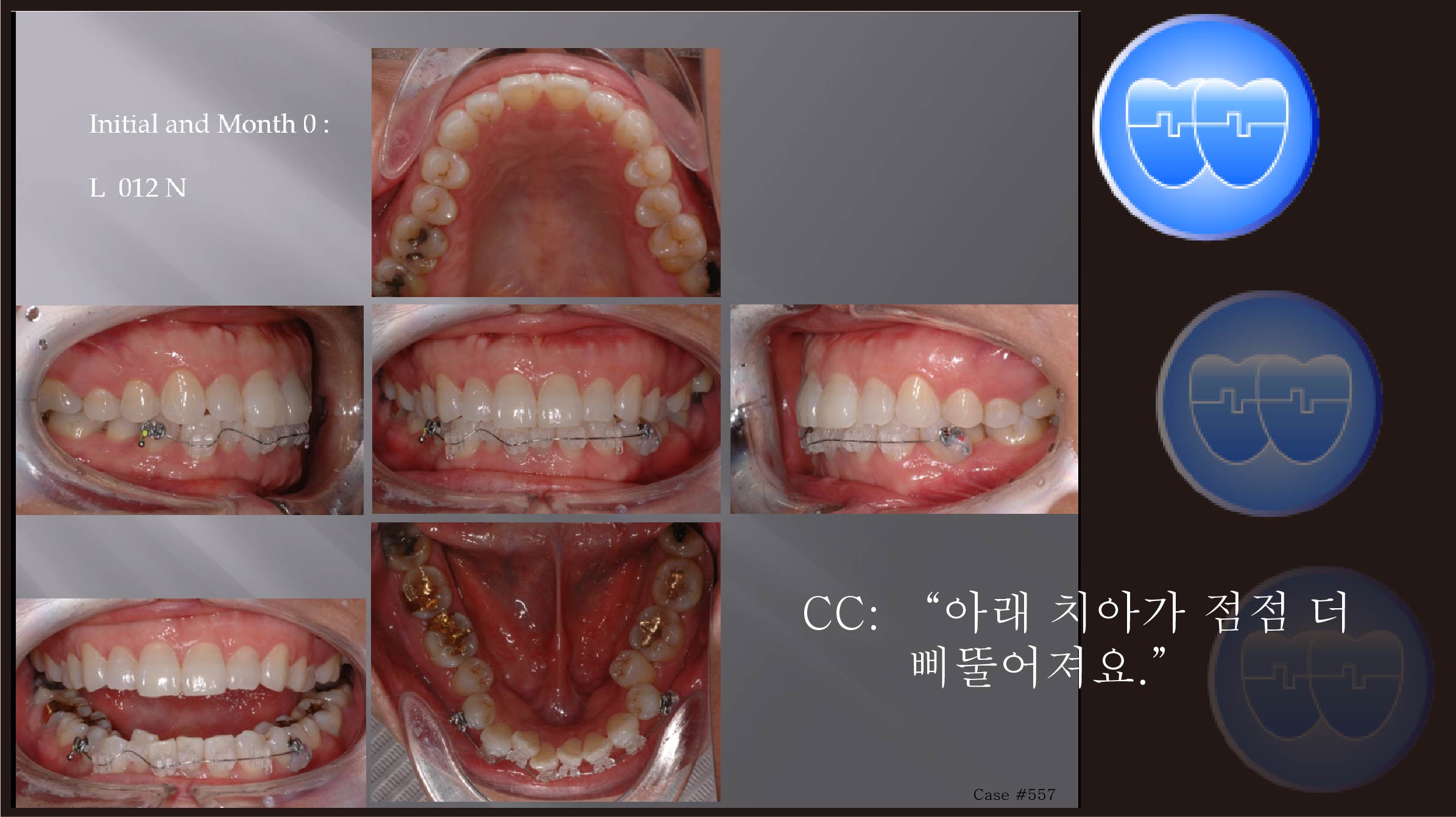 교정 Case 557.  비발치, Lower Crowding, 부분교정, Sem #11