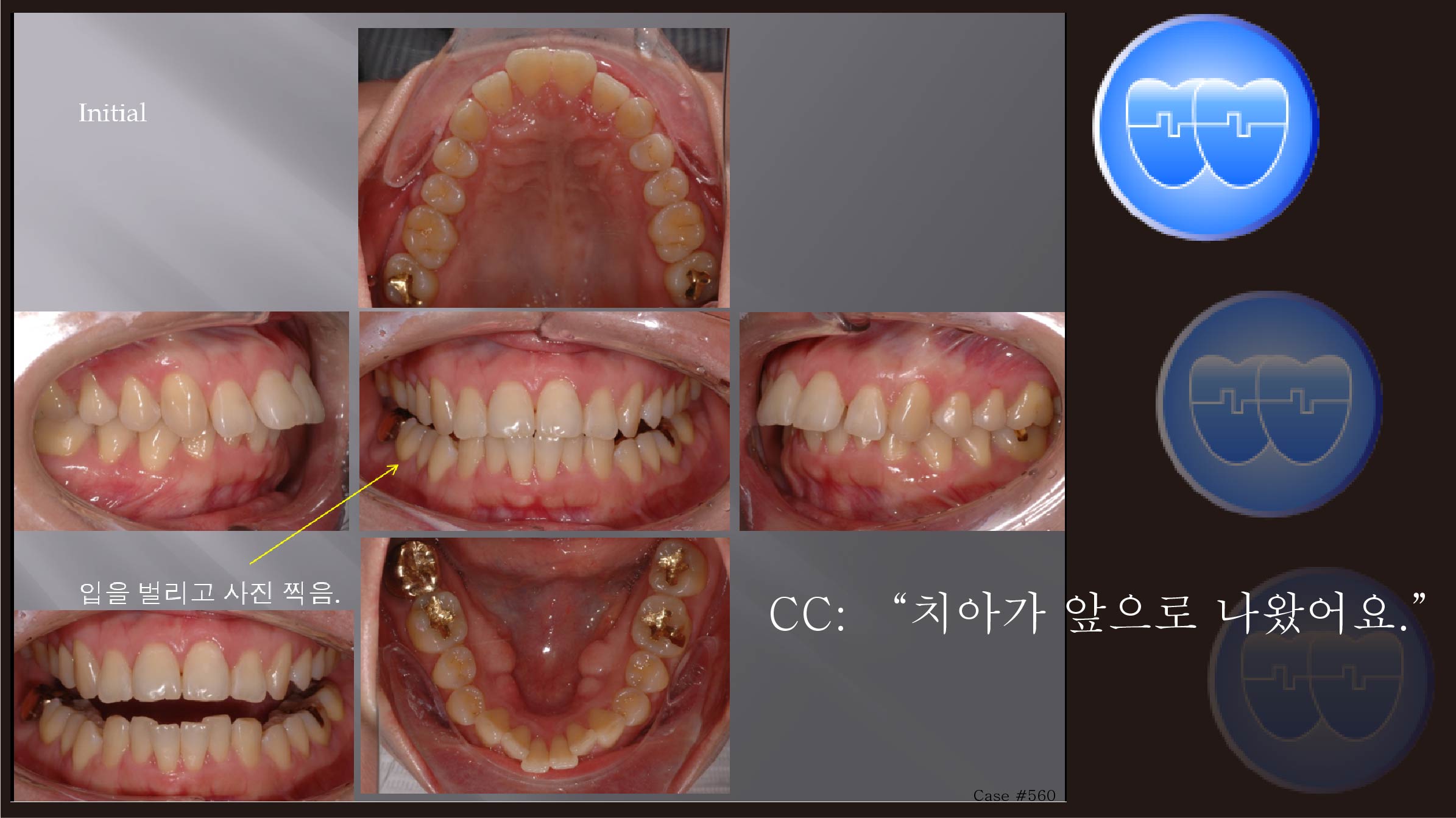 교정 Case 560.  U5 발치, Class II, Severe Overjet, Sem 12.6