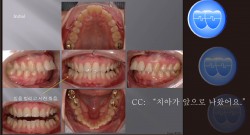 교정 Case 560.  U5 발치, Class II, Severe Overjet, Sem 12.6