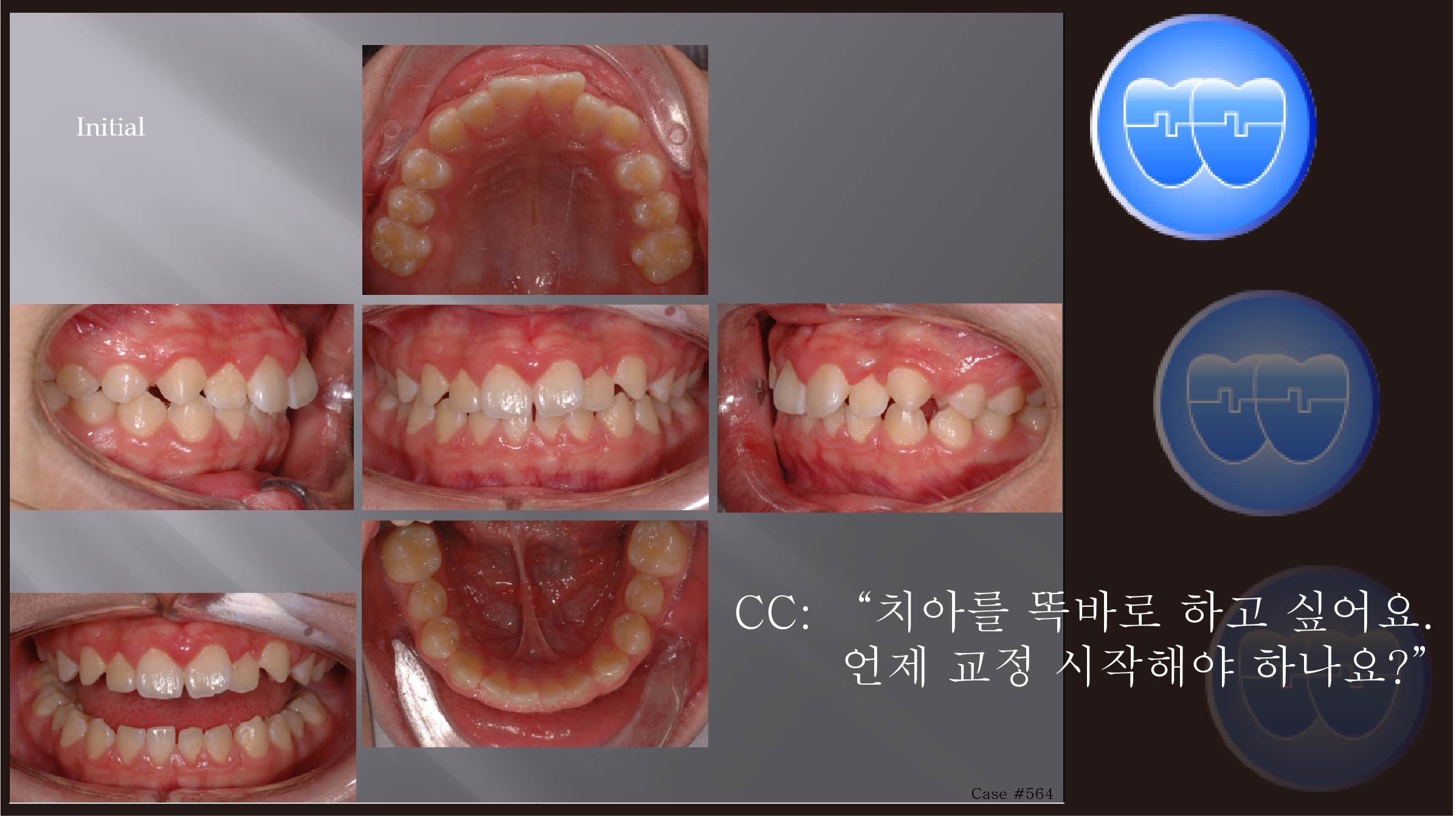 교정 Case 564.  비발치, Tilted Occlusion Table, Miniscrew 실수, Sem #5.5