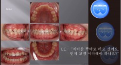 교정 Case 564.  비발치, Tilted Occlusion Table, Miniscrew 실수, Sem #5.5