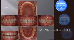 교정 Case 578.  비발치, Space Control 방법, Gingivectomy, Sem #11