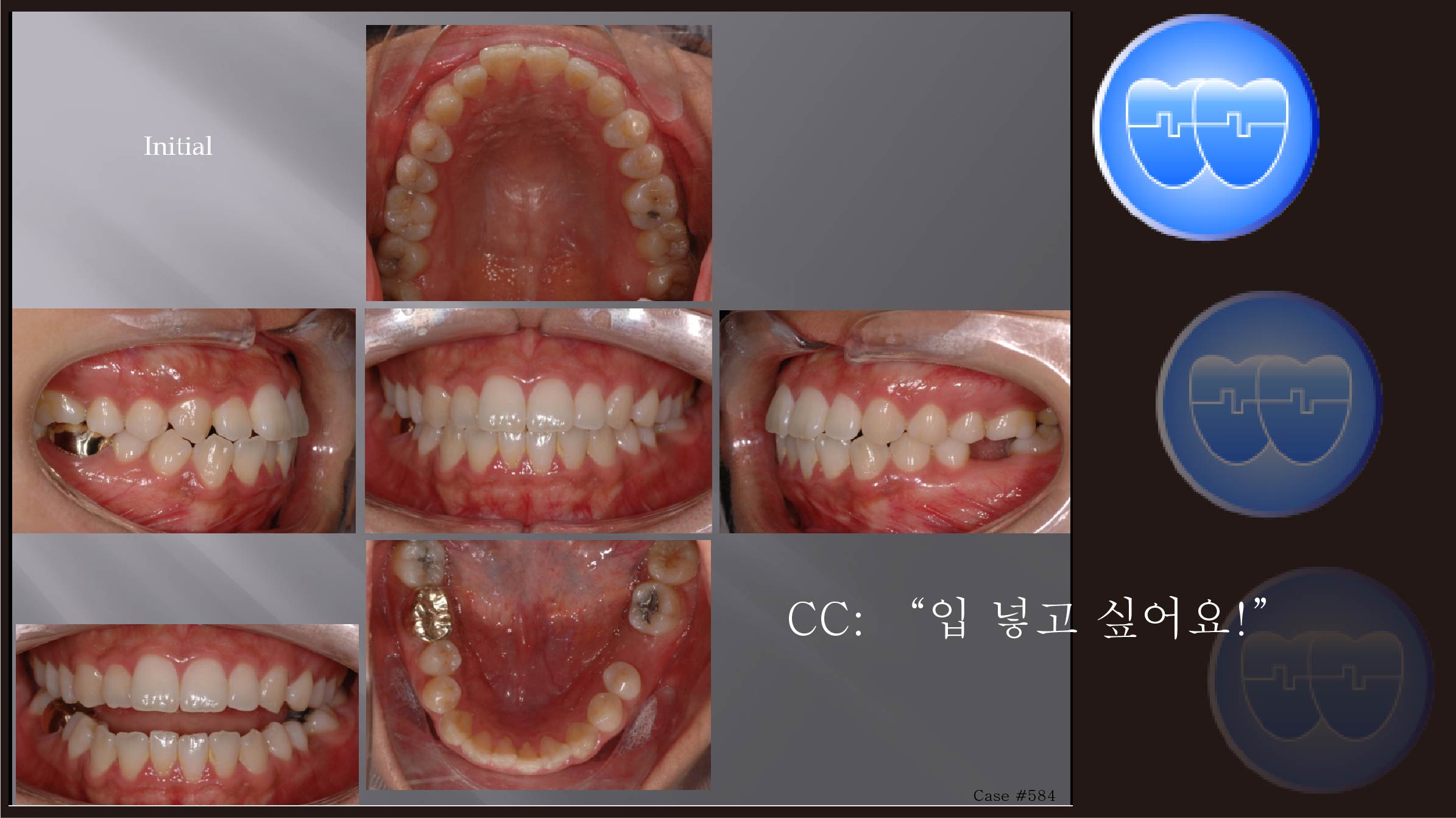 교정 Case 584.  비대칭 발치, Molar Substitution, Sem 13.2