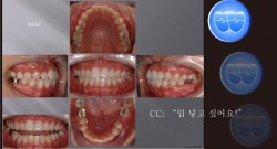 교정 Case 584.  비대칭 발치, Molar Substitution, Sem 13.2