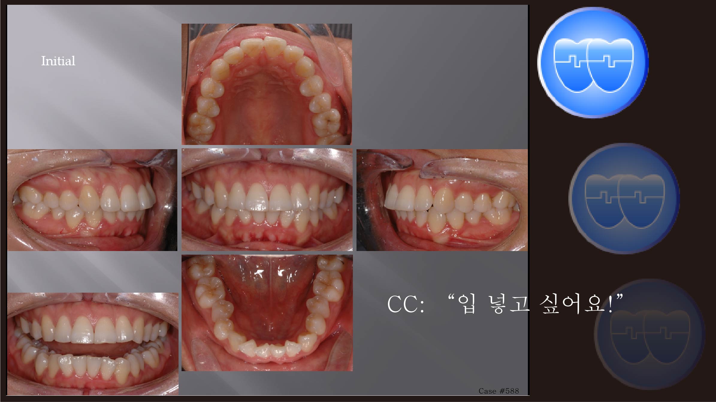 교정 Case 588.  U5L5 발치, Protrusion, Class II, Sem #12.4