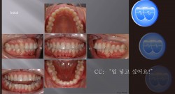 교정 Case 588.  U5L5 발치, Protrusion, Class II, Sem #12.4