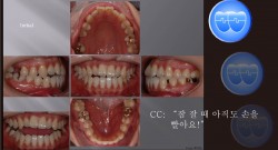 교정 Case 589.  비대칭 발치(16,25,36,44), Dental Midline, Thumb Sucking, Sem #13.2