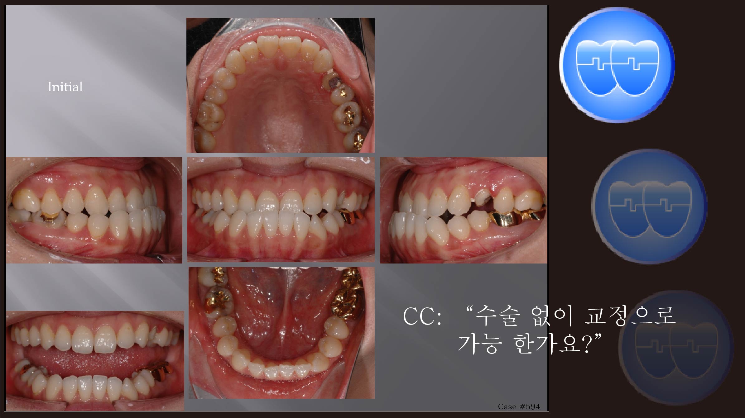 교정 Case 594.  L4 발치, Lower Lingual Corticotomy, Sem #12.7