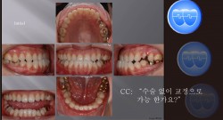 교정 Case 594.  L4 발치, Lower Lingual Corticotomy, Sem #12.7