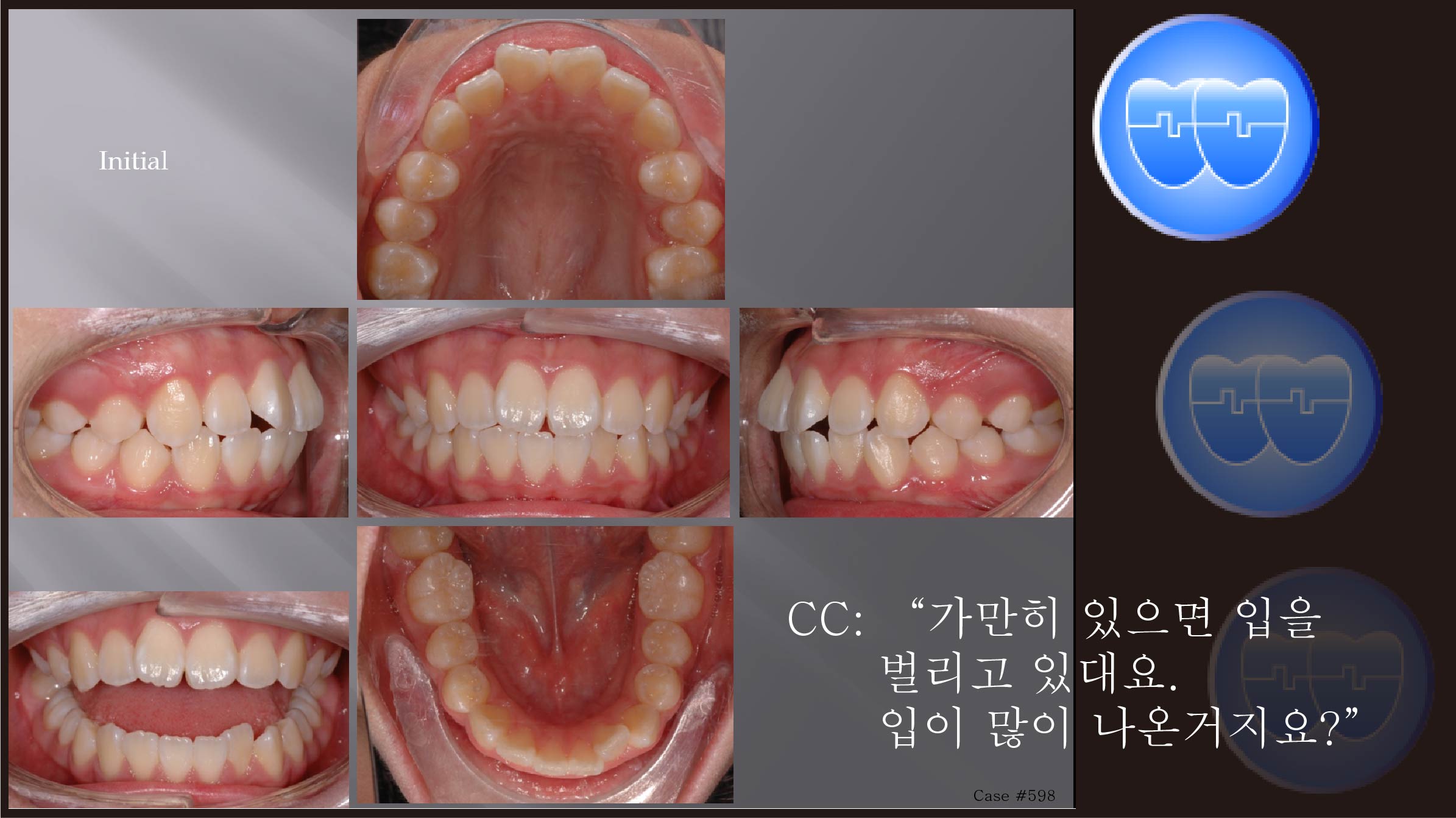 교정 Case 598.  U5L5 발치, 의심스러운 Long Face, Sem #10