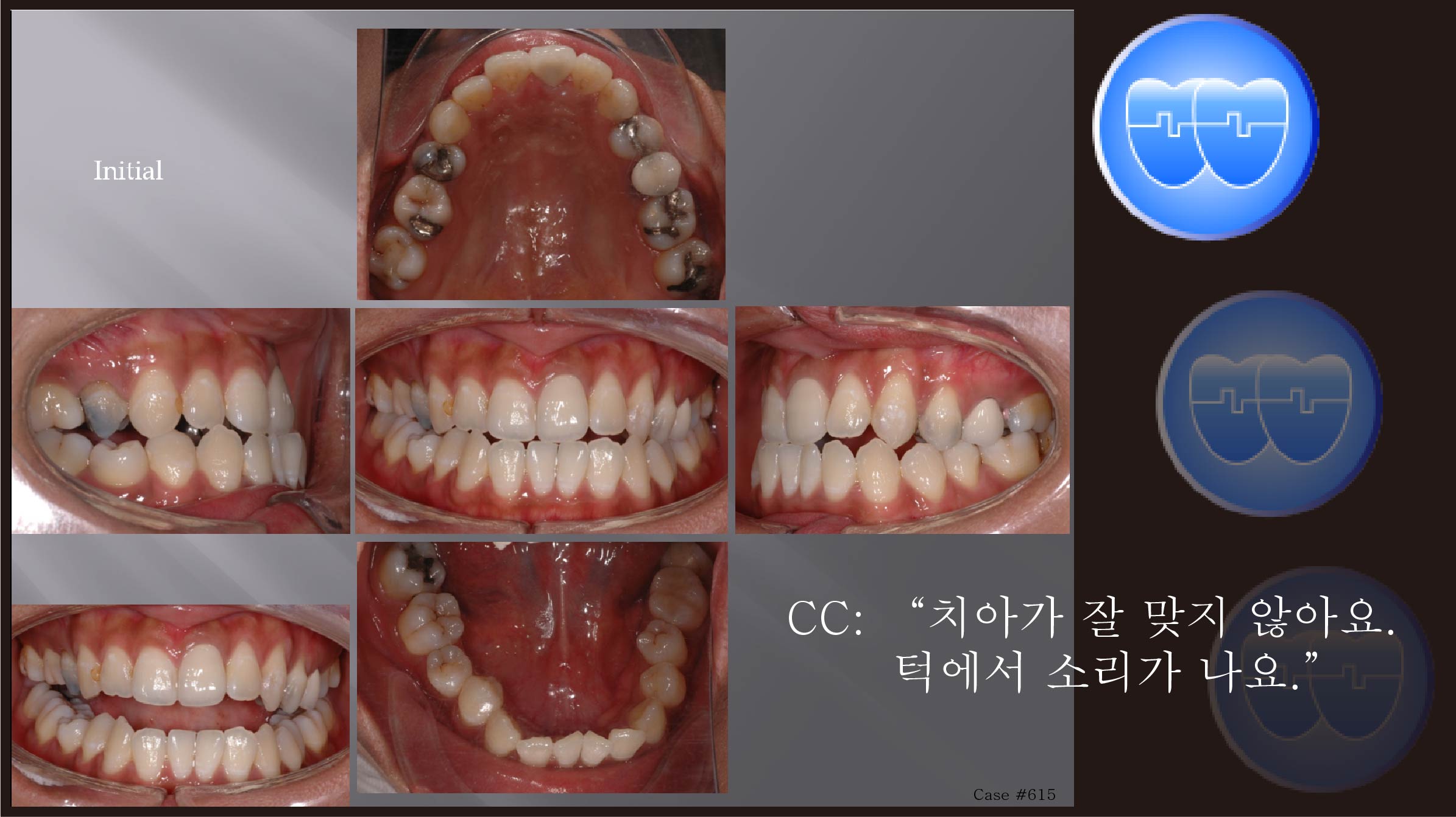 교정 Case 615.  비대칭 Upper Arch, Class III, Midline Correction, Sem #6