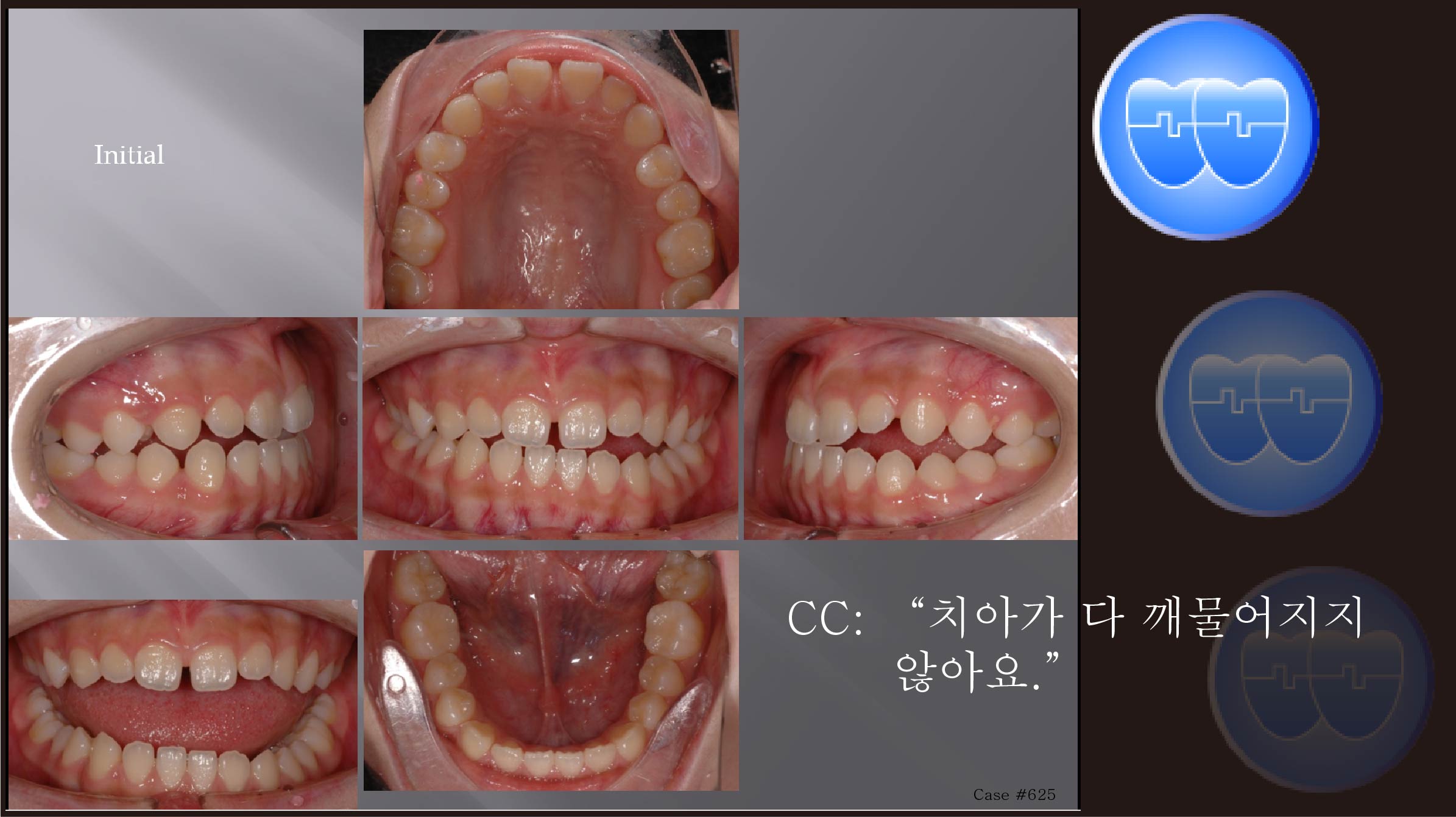 교정 Case 625.  비발치, Dental Openbite, Sem #7