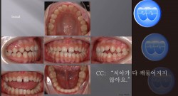 교정 Case 625.  비발치, Dental Openbite, Sem #7