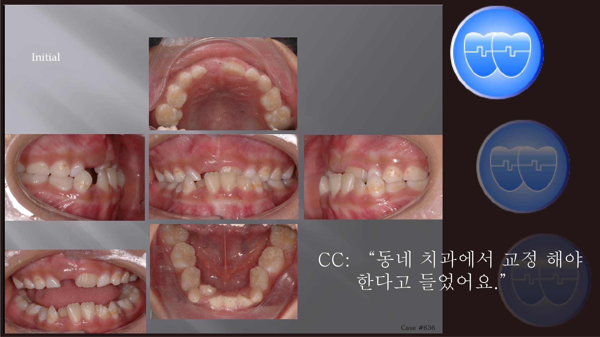 교정 Case 636.  1차 교정, Advancing Z Arch, Anterior Crossbite, Sem #9