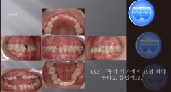 교정 Case 636.  1차 교정, Advancing Z Arch, Anterior Crossbite, Sem #9