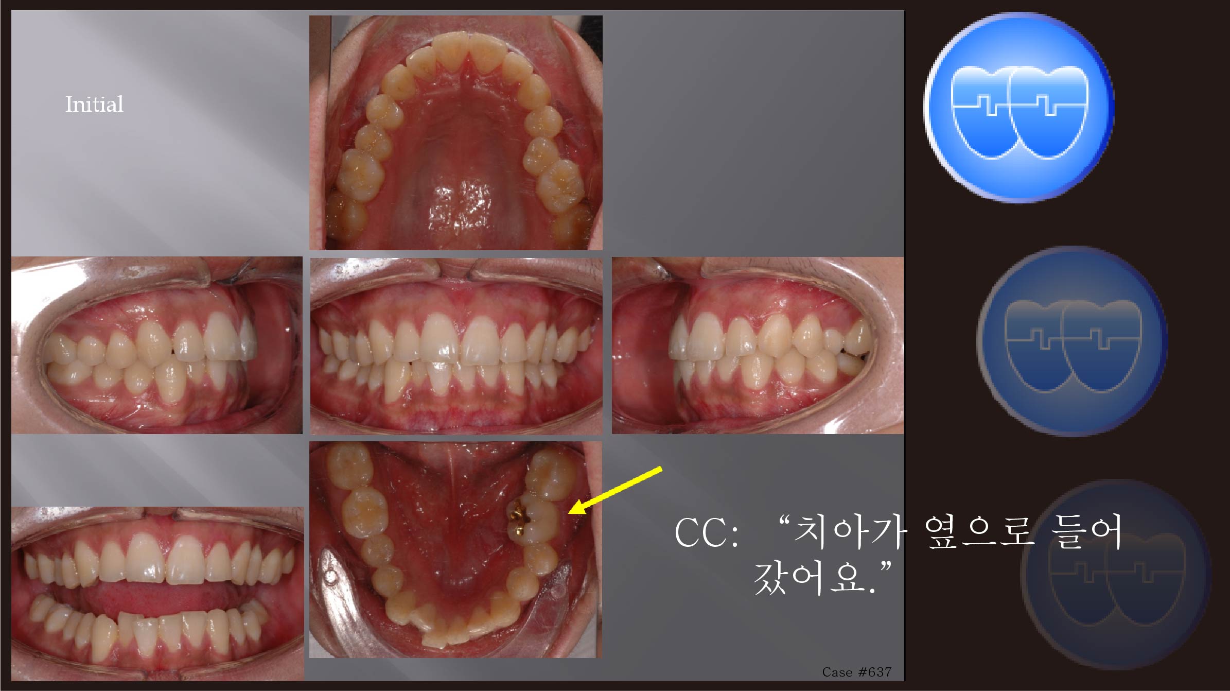 교정 Case 637.  U5L5 발치, Posterior Scissor-bite, Strong Muscle, Sem #7.8