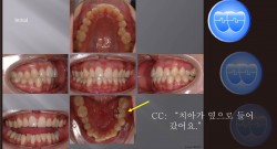 교정 Case 637.  U5L5 발치, Posterior Scissor-bite, Strong Muscle, Sem #7.8