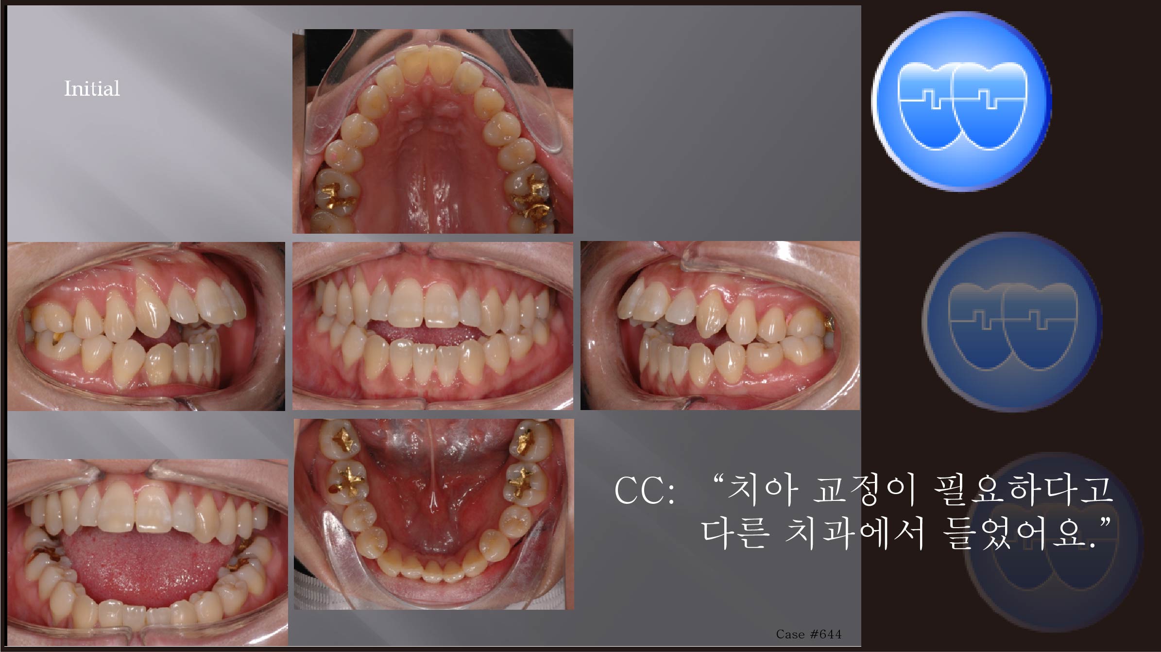 교정 Case 644.  U5L1 발치, Openbite, Severe Class II, Upper Palatal Corticotomy, Sem #7