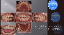 교정 Case 644.  U5L1 발치, Openbite, Severe Class II, Upper Palatal Corticotomy, Sem #7