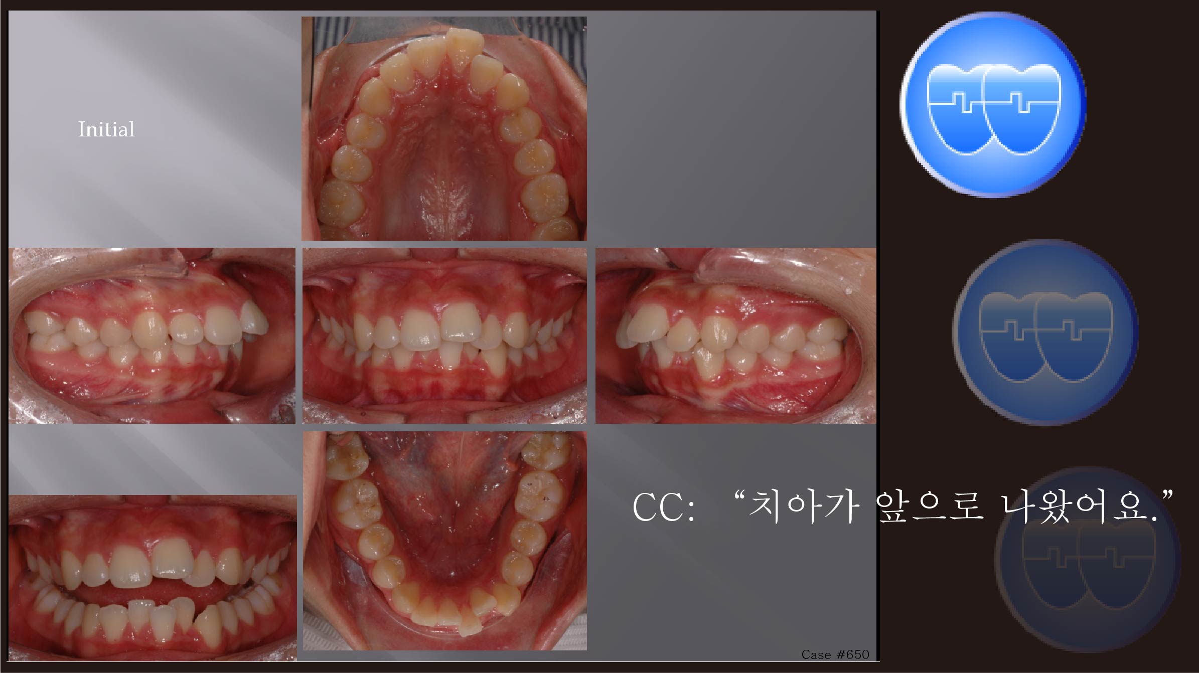 교정 Case 650.  U5 발치, Deepbite, Gummy Smile 가능성. Sem #6