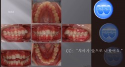 교정 Case 650.  U5 발치, Deepbite, Gummy Smile 가능성. Sem #6