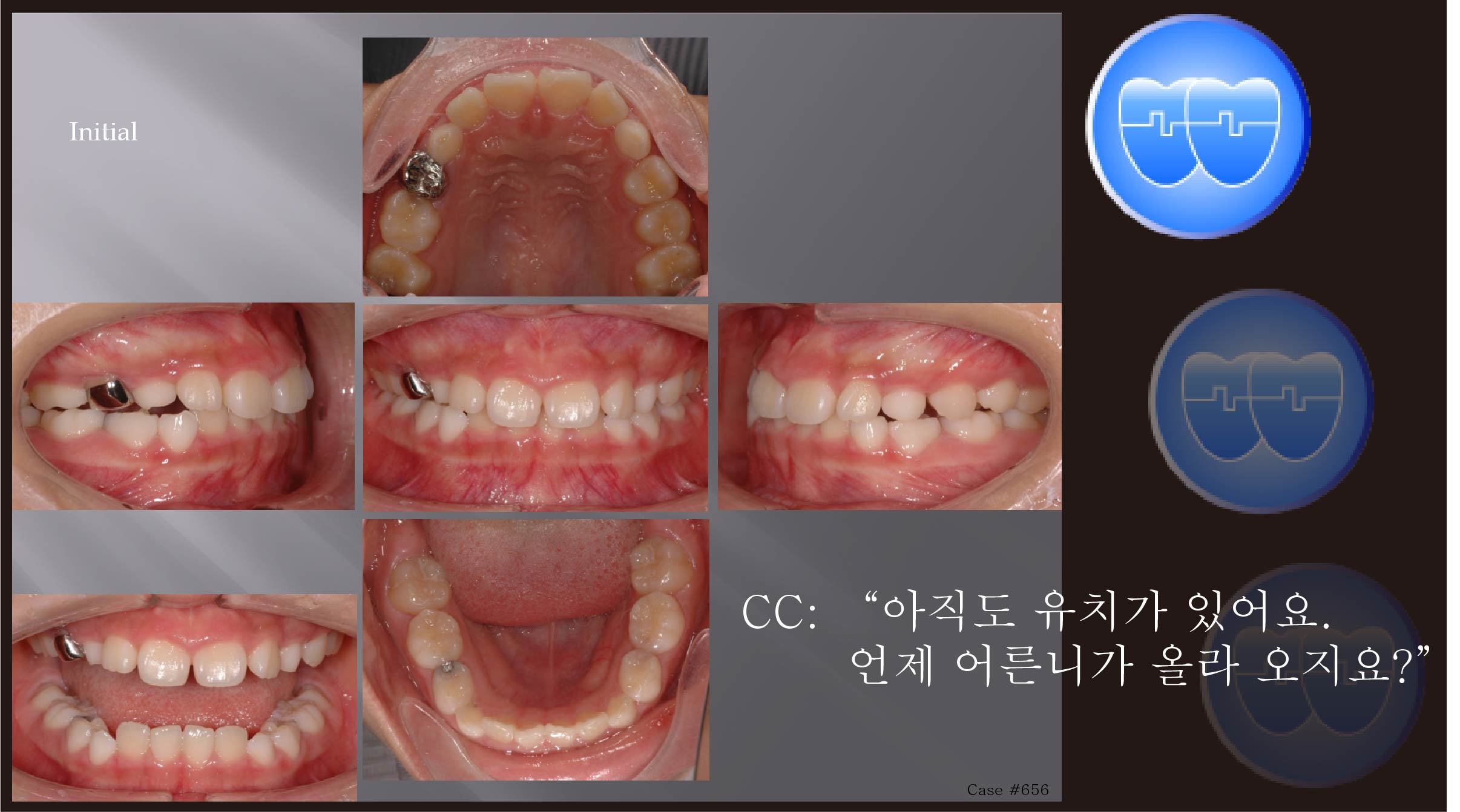 교정 Case 656.  비발치, Late Eruption Problem, Sem #9