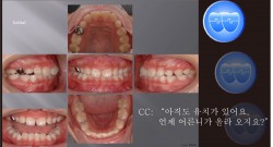 교정 Case 656.  비발치, Late Eruption Problem, Sem #9