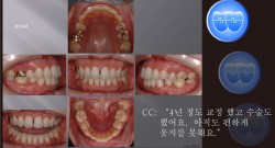 교정 Case 669.  U4L4 발치, 재교정, Severe Gummy Smile, Sem #7.5