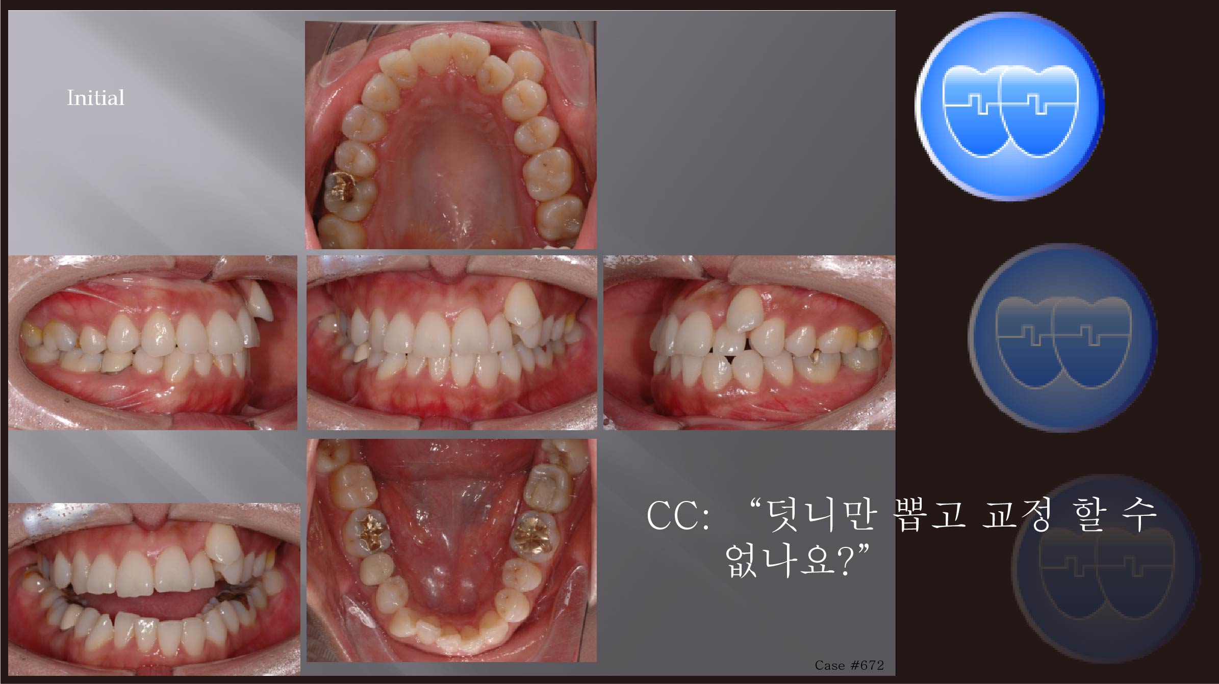 교정 Case 672.  비대칭 발치, Asymmetric TMJ. 심각한 비대칭, Functional Shift, #19