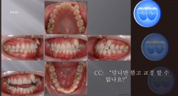 교정 Case 672.  비대칭 발치, Asymmetric TMJ. 심각한 비대칭, Functional Shift, #19