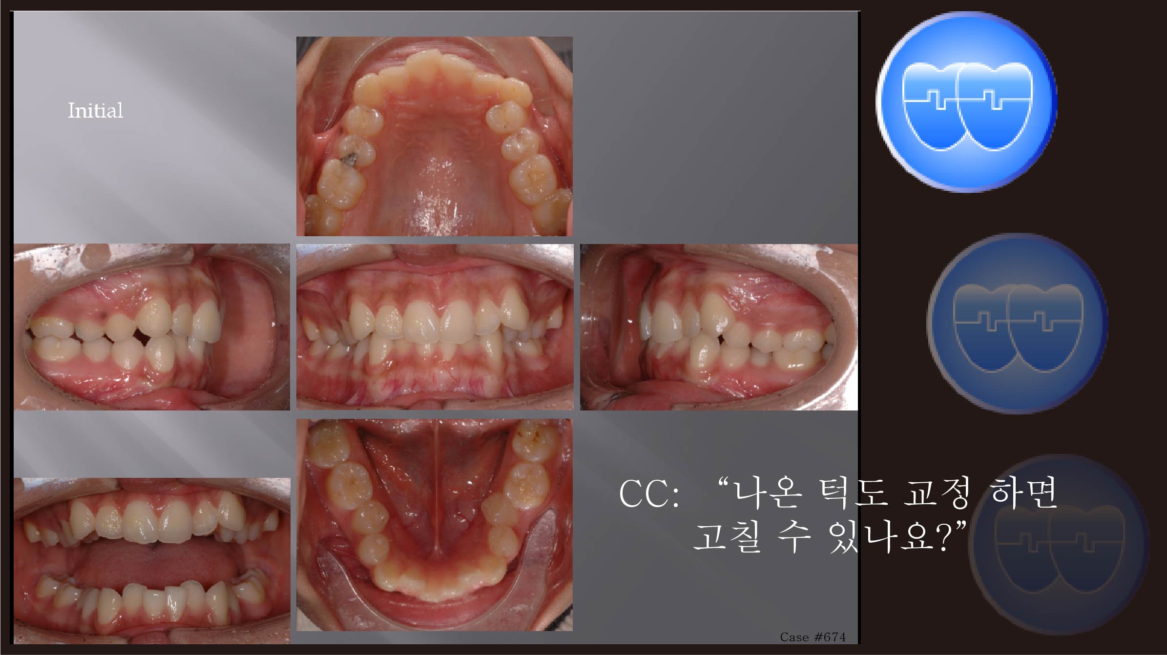 교정 Case 674.  U5L4 발치, Strong Muscle, Detorqued Anterior Teeth, 진단실수, Sem #12.3