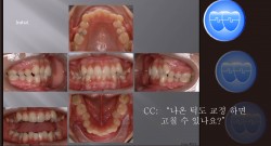 교정 Case 674.  U5L4 발치, Strong Muscle, Detorqued Anterior Teeth, 진단실수, Sem #12.3