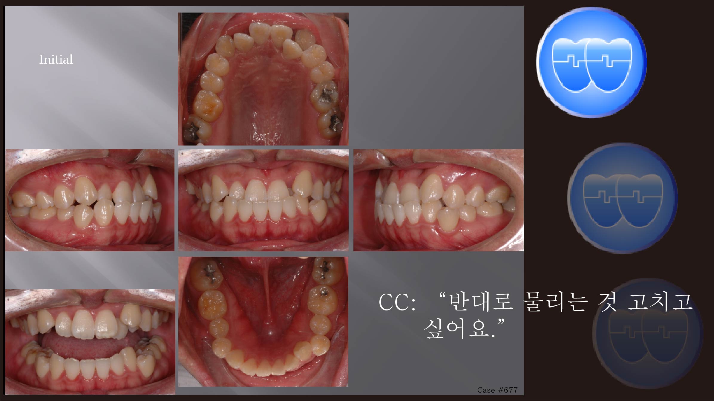 교정 Case 677.  One Lower Incisor 발치, 비발치로 시작, Class III, Anterior Crossbite, 진단실수, Lower Lingual Corticotomy, Sem #13