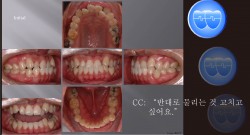 교정 Case 677.  One Lower Incisor 발치, 비발치로 시작, Class III, Anterior Crossbite, 진단실수, Lower Lingual Corticotomy, Sem #13