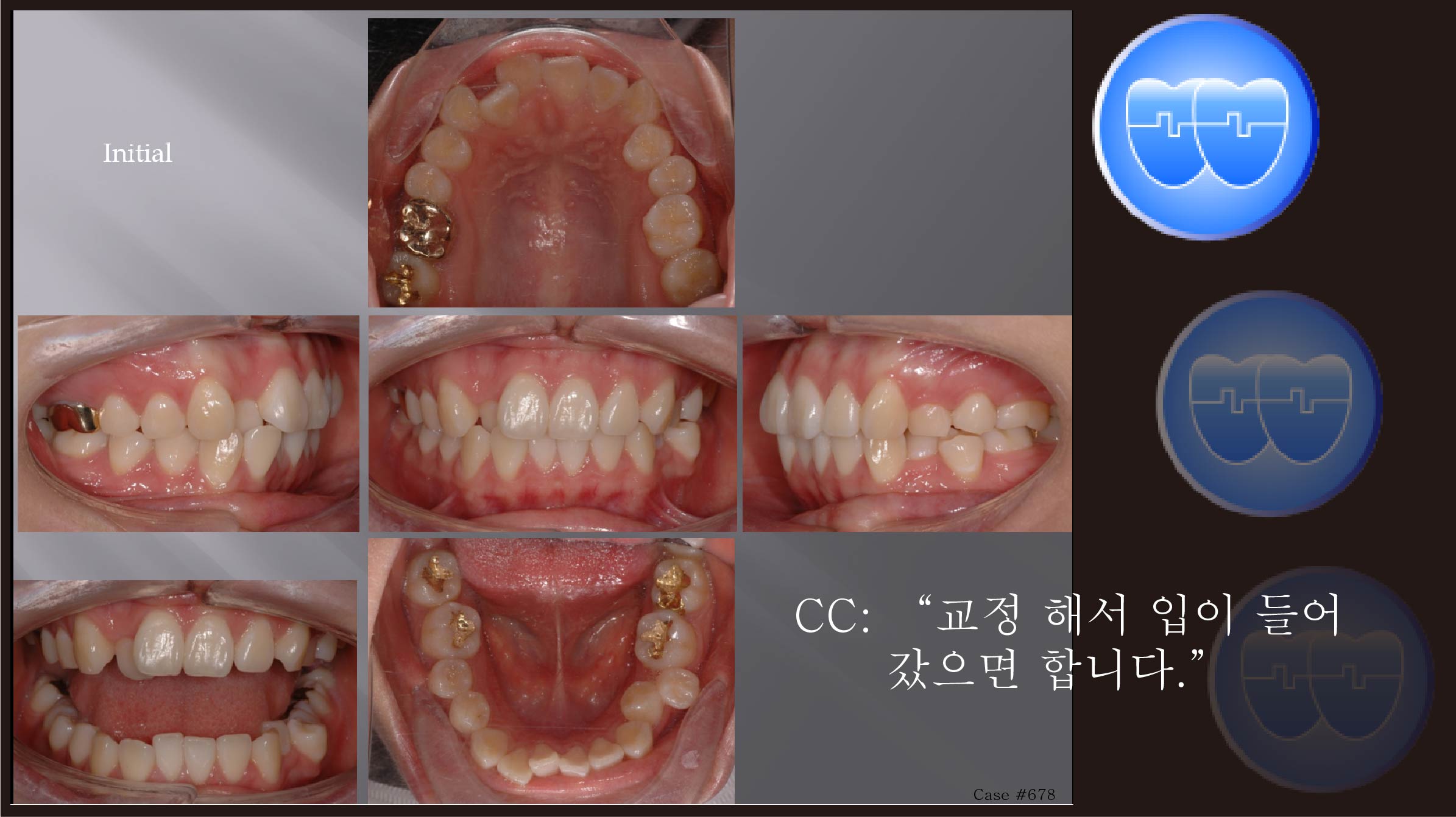 교정 Case 678.  U5L4 발치, Crowding, Protrusion, Sem # 12.3