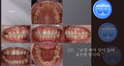 교정 Case 678.  U5L4 발치, Crowding, Protrusion, Sem # 12.3