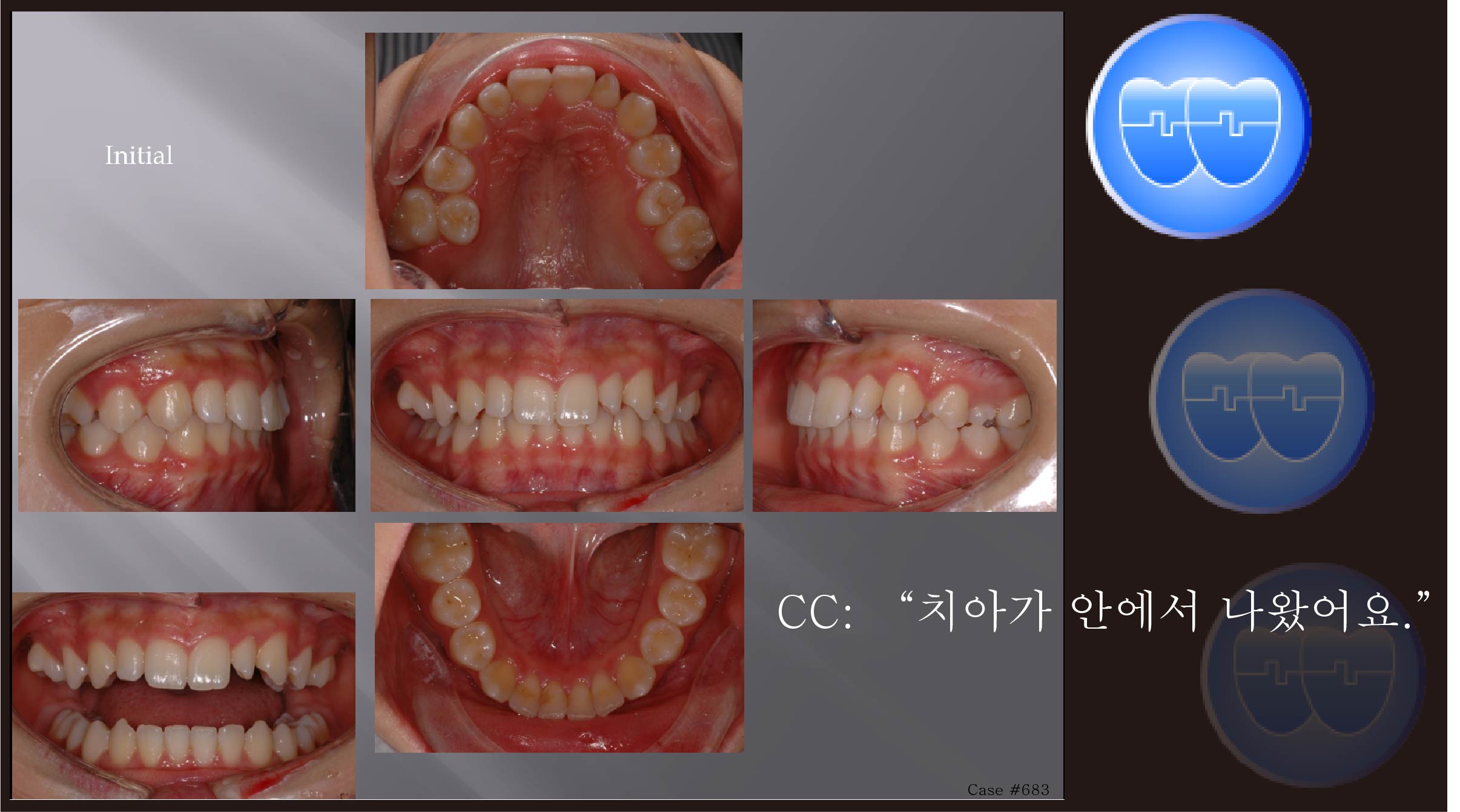 교정 Case 683.  15번 발치, 비대칭 발치, Sem #13.2