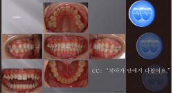 교정 Case 683.  15번 발치, 비대칭 발치, Sem #13.2