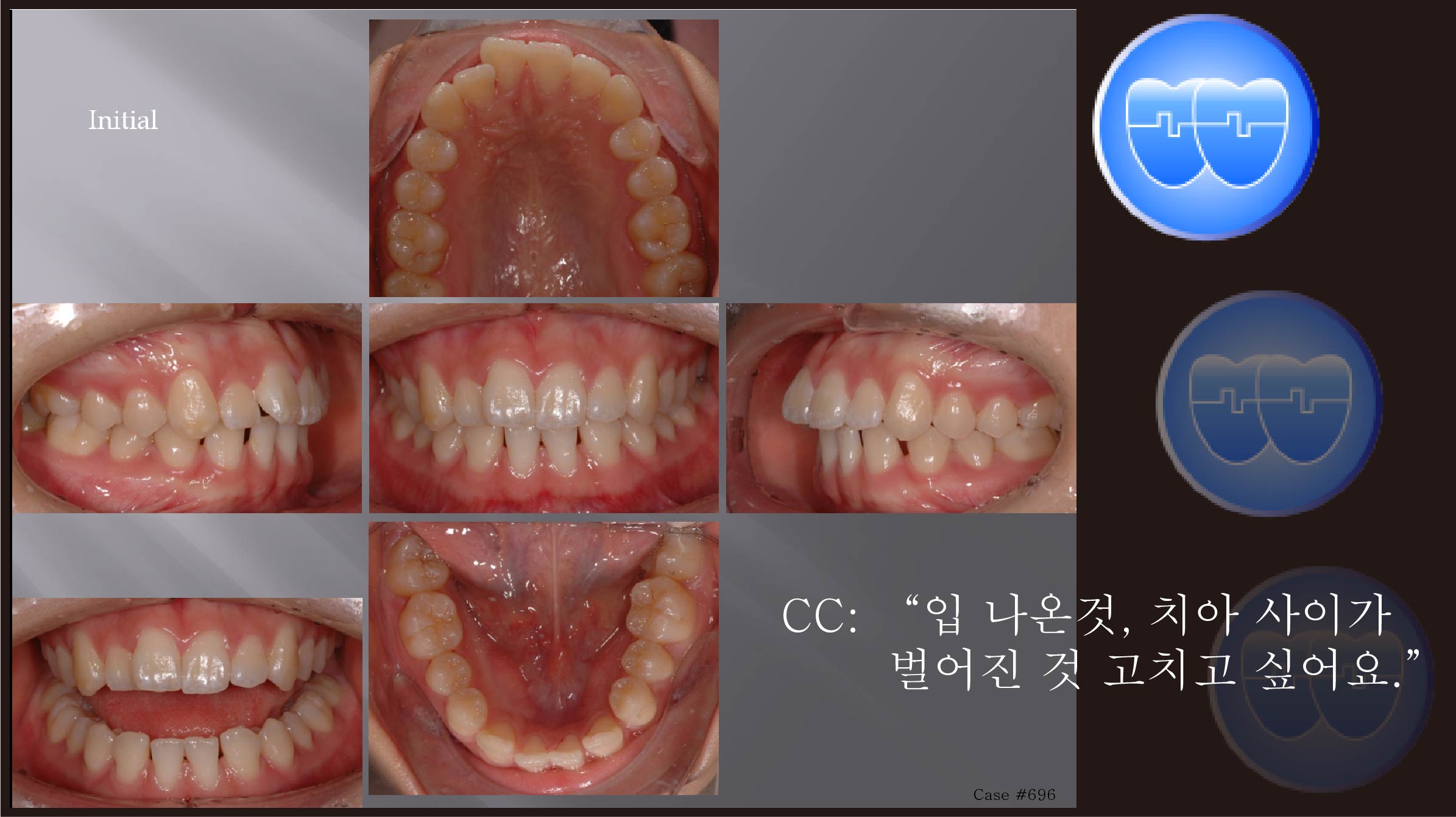 교정 Case 696.  U5L2 발치, Gummy Smile, Tight Lips, Two Lower Incisors Missing, Sem #7.5