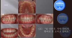 교정 Case 696.  U5L2 발치, Gummy Smile, Tight Lips, Two Lower Incisors Missing, Sem #7.5