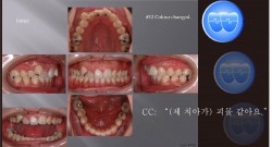 교정 Case 709.  12번 발치, 22번 Congenital Missing, Skeletal Class II, Skeletal Resistance, Root Resorption, Prosth-Ortho, Sem #13