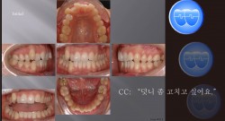 교정 Case 711.  U5 발치, Class II, 시갈버튼, Bilateral Posterior Crossbite, Sem #7.8