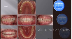 교정 Case 716.  U5L4 발치, Protrusion, Root Resorption, Detorqued Incisors, Sem #12.3